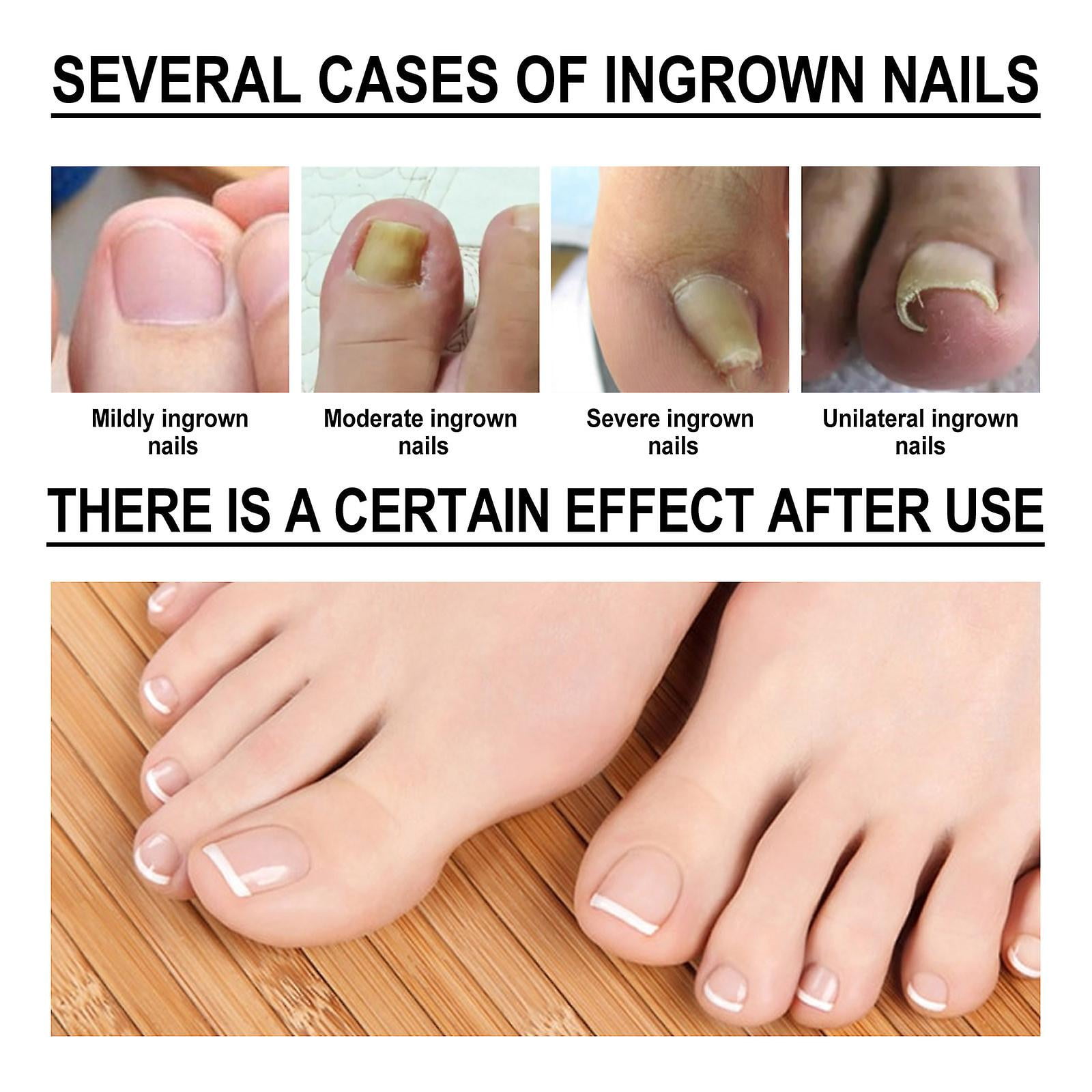 Ingrown Toenail Correction Treatment Kit, 50PCS Repair Sticker Patches –  TweezerCo