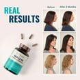 thumbnail image 5 of Live Conscious Hair La Vie Clinical Formula Hair Vitamins for Hair Regrowth, 90 Caps (Pack of 1), 5 of 10