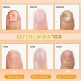 thumbnail image 3 of Bee Venom Nail Repair Serum, Natural Nail Care Solution, Ingrown Toenail Care Spray, Bee Venom Nail Care Soothing Spray, 3 of 5