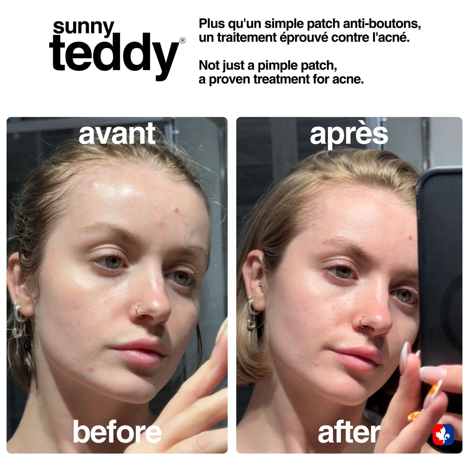 Sunny Teddy Patchs anti-acné – Patch hydrocolloïde à l'acide salicylique, invisible et doux pour la peau, 36 unités 12 petits/24 gros = 36 patchs