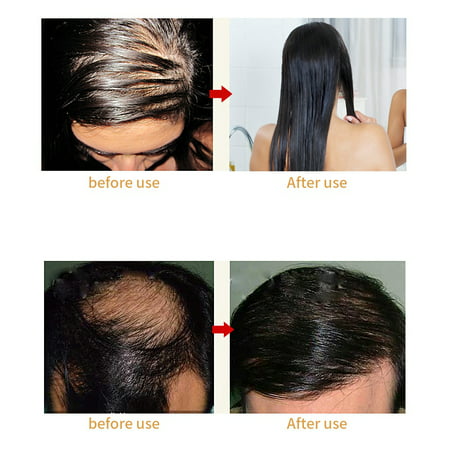 Garosa Anti Hair Loss Comb, Hair Regrowth Brush, Laser Hair Growth Comb  Anti Hair Loss Massager Hair Regrowth Comb Brush | Walmart Canada
