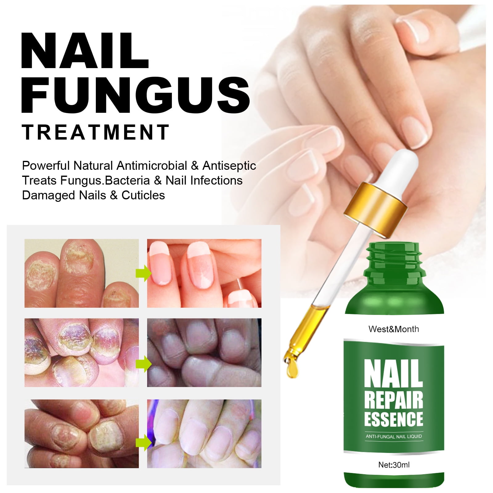 get #rid #of #yellowing #toe #nail #fungus #holostic #health #fypシ #f... |  TikTok