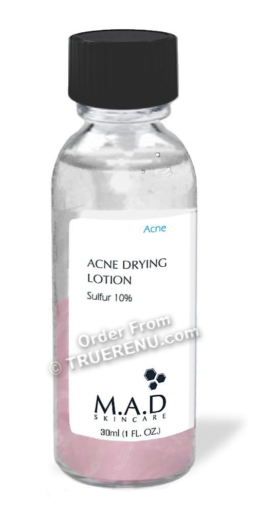 acne drying cream
