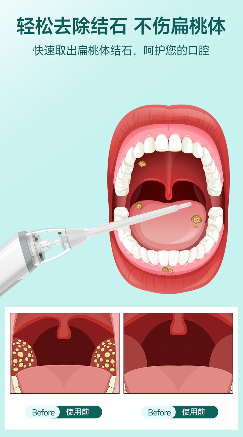 iKeener New Home Oral Care Tool Set Tonsil Electric Suction Stone Remover Stone Removal Tool Suction Tonsil Stone Sucker