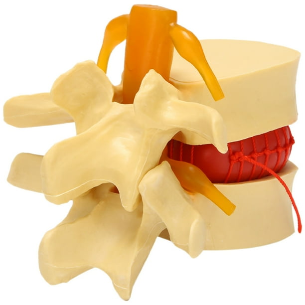 Lumbar Vertebrae Model Anatomical Spine Lumbar Disc Herniation Anatomy