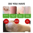 thumbnail image 4 of Ungüento de Psoriasis a base de hierbas naturales, tratamiento de Dermatitis, Eczema, crema antibacteriana, cuidado antiprurítico DE LA PIEL, 4 of 5