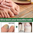 thumbnail image 4 of Essential Oil Nail Fungus Repair Liquid Nail Thickening Discoloration Off Soft Nail Thickening Type Onychomyc 20m, 4 of 5
