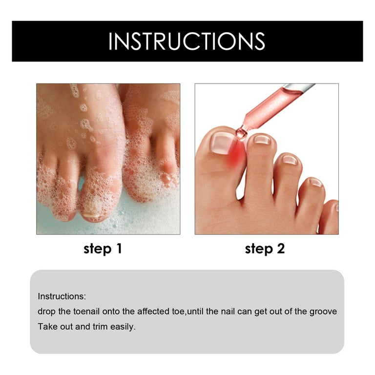 In growth sale toenail treatment