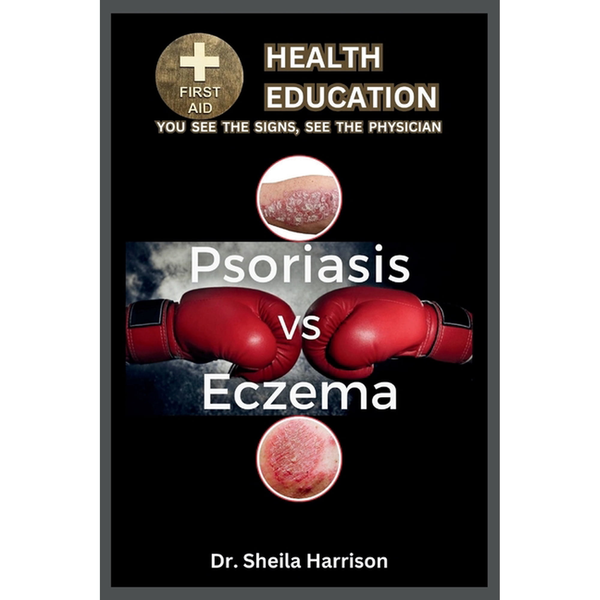 Sheila's Health Education Book Shelf: You See the Signs, See the Physician: Psoriasis vs. Eczema: Differences, Similarities, Types, Symptoms, Causes, Diagnosis, Treatment, Medications, Prevention & Co