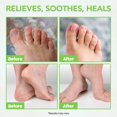 thumbnail image 3 of Bálsamo para el tratamiento de pies de atletas THENA Extra Strength Tea Tree, 3 of 6