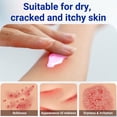 thumbnail image 2 of Crema de eccema LMNOOP para piel seca, con picazón, irritada y propensa al eccema, ungüento de tratamiento de fuerza máxima para erupción, psoriasis, dermatitis, beriberi, 3.53 oz Vhermosa MGL-CC018, 2 of 6