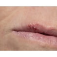 thumbnail image 3 of Releev 1 Day Cold Sore Symptom Treatment, Soothing, 0.20 oz, 6 ml, 3 of 5