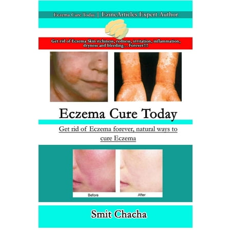 Eczema Cure Today - Get rid of Eczema forever natural ways to cure (The Best Way To Get Rid Of Canker Sores)