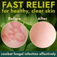 thumbnail image 5 of Antifungal Body Cream for Ringworm & Athlete’s Foot | Strength Formula with Tea Tree Oil | Helps With Itching, Burning & Scaling Relief | Treatment For Skin Fungus | 4.05 fl oz, 5 of 8