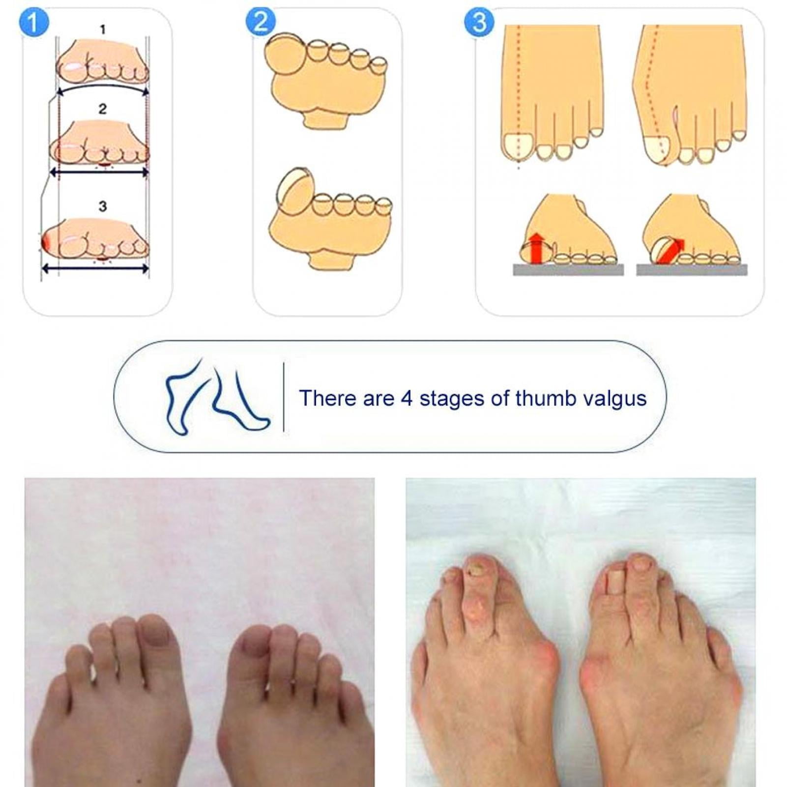 Buy Tebru Woman Bunion Corrector,Hallux Valgus Corrector,Adult Unisex