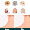 thumbnail image 1 of 120 Uds parche eliminador de marcas en la piel pegatinas para el tratamiento de verrugas yeso de absorción rápida Likrtyny  cuidado belleza, 1 of 2
