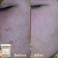 thumbnail image 5 of Acne Solution Kit for Face by Aniise, 5 of 5