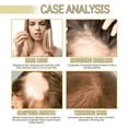 thumbnail image 3 of Veganic Natural Hair Growth Oil, Rosemary Oil For Hair Growth Organic, Pure Natural Hair Density Essential Oil, Plant Extract Hair Growth Oil for Dry Damaged Hair and Growth (2PCS), 3 of 6