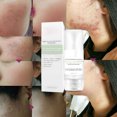 thumbnail image 1 of Crema para eliminar el acné, crema para espinillas, crema Facial hidratante de reparación para el cuidado de la piel, 30ml, 1 of 8