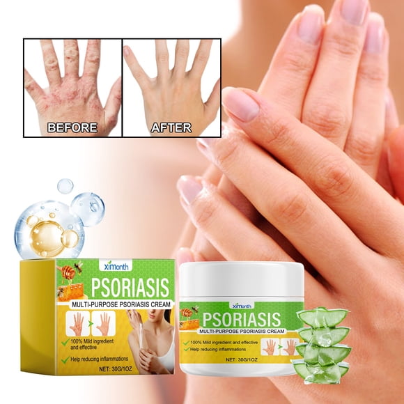 Dry Elbows Psoriasis
