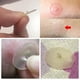 thumbnail image 3 of Acné Espinillas Parche Pegatinas Tratamiento Del Acné Removedor De Espinillas Para, 3 of 5