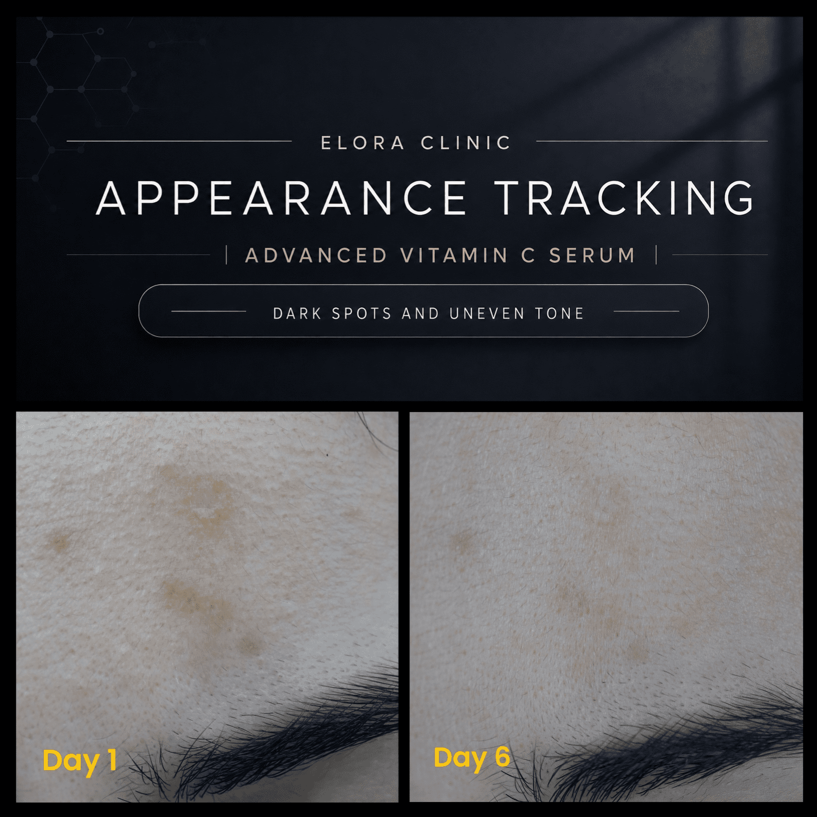 Elora Clinic Vitamin C Serum with Hyaluronic Acid– brightening and pore minimizer – Advanced Vitamin c with glow and hydration
