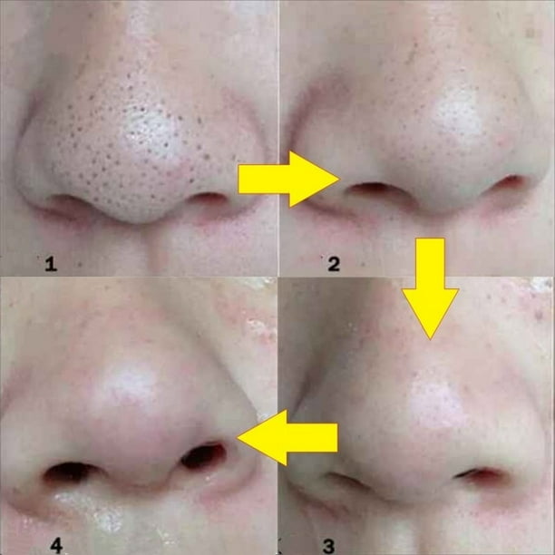 Mascarilla para eliminar puntos negros de la nariz Tira de poros de contracción profunda (Butterfly Black) Tmvgtek Cuidado Belleza | Walmart en línea