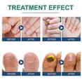 thumbnail image 2 of 3 paquetes de parches para el tratamiento de hongos en las uñas, parches para reparar uñas, tratamiento para reparar hongos en las uñas, parches para reparar hongos en las uñas por onicomicosis, 2 of 5
