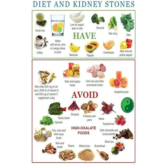 Kidney Stone Diet Healthy nutrition checklist poster meal planning healthy cooking poster, wall decoration suitable for kitchen living room bedroom poster