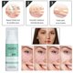 thumbnail image 5 of Crema antiacné, , tratamiento suave para el acné, reducción de , eliminación de espinillas, atención facial, blanqueamiento, inflamación, Yinane Eliminación, 5 of 8