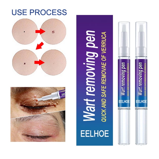 2 uds removedor de verrugas pluma para etiquetas de piel papilomas eliminación de lunares herramientas de punto indoloras Sywqhk Cuidado Belleza