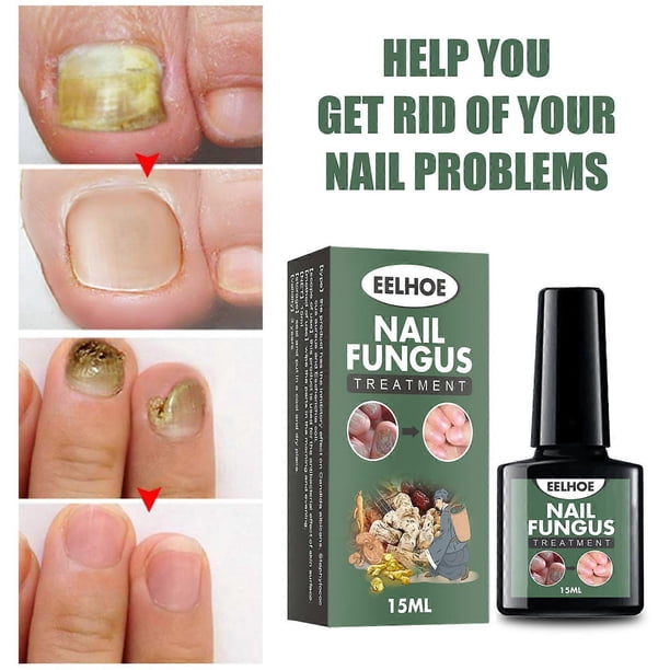Solución para el cuidado de las uñas de los pies, tratamiento para uñas dañadas, renueva las uñas de los pies dañadas y descoloridas (15 ml)