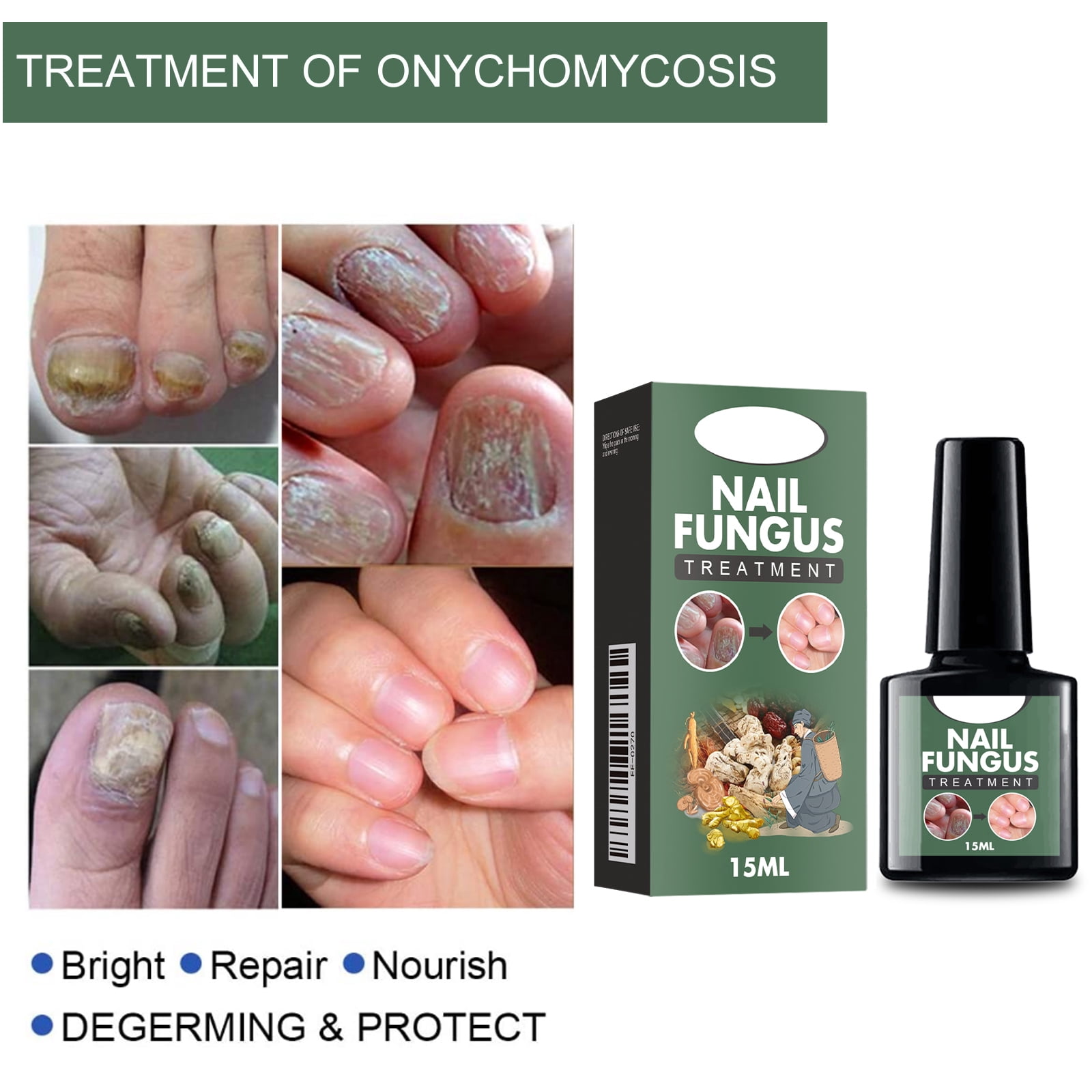 Alvantor Nail Fungus Treatment Solution for Thickened and Softened Damaged Nails, 0.5fl oz