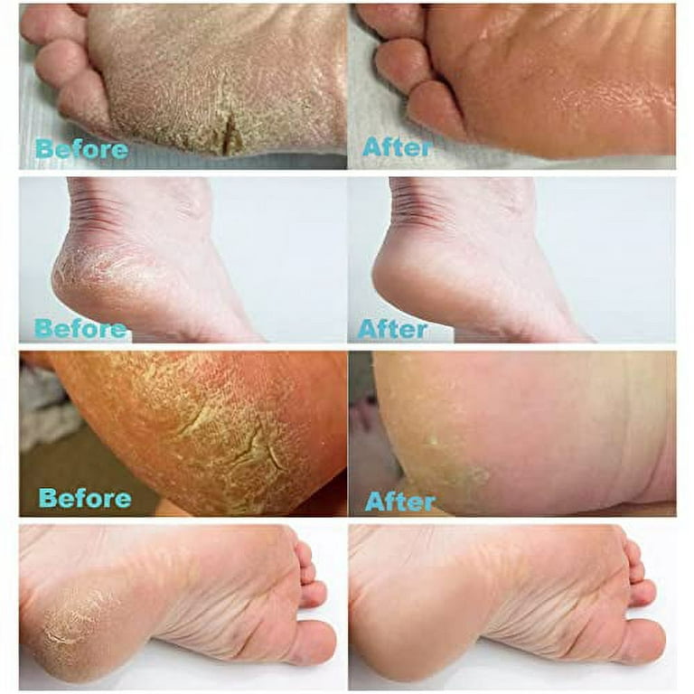 Urea Cream 40 percent for Feet Maximum Strength, Best Callus Remover For  Feet, Knees& Elbows, Natural Moisturizes Nourishes Softens Dry, Rough