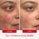 thumbnail image 4 of Hidratante para rostro y cuerpo First Aid Beauty Ultra Repair 57 g, 4 of 9