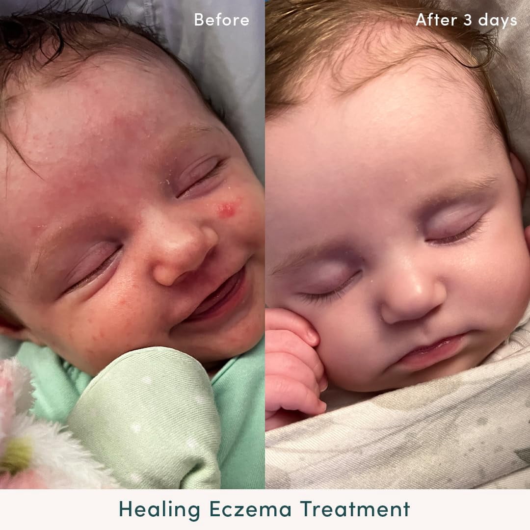 Evereden Healing Eczema Treatment, 1.7 fl oz | Safe & Efficient Eczema Cream | Gentle & Fragrance Free Eczema Cream for Babies, Kids, and Adults