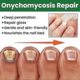 thumbnail image 3 of Essential Oil Nail Fungus Repair Liquid Nail Thickening Discoloration Off Soft Nail Thickening Type O, 3 of 5