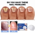 thumbnail image 4 of Nail Fungus Laser Treatment Device Portable Painless Nail Fungus Treatment Device for Men Women Nail Treatment, 4 of 5