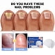 thumbnail image 4 of Nail Fungus Laser Treatment Device Portable Painless Nail Fungus Treatment Device for Men Women Nail Treatment, 4 of 5