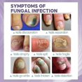 thumbnail image 2 of 2pcs Medinail Fungus Spray New Lucky_b, 2 of 5