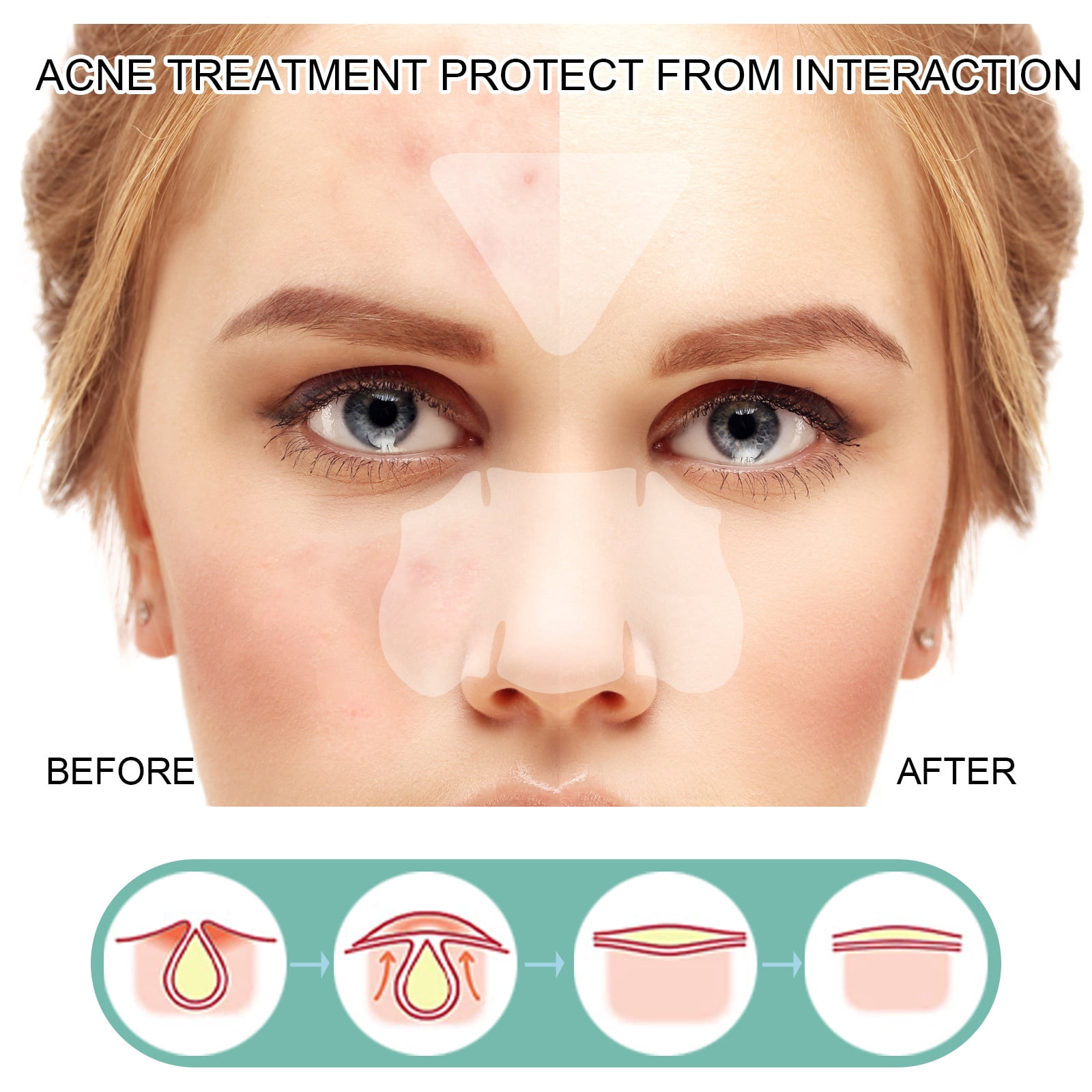 Alvantor Acne Patches Hydrocolloid Pimple Patches for Face, Zit Cover Invisible Spot Stickers, 132Patches