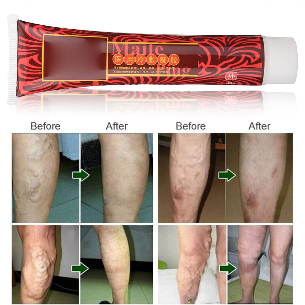 10 home remedies for varicose veins