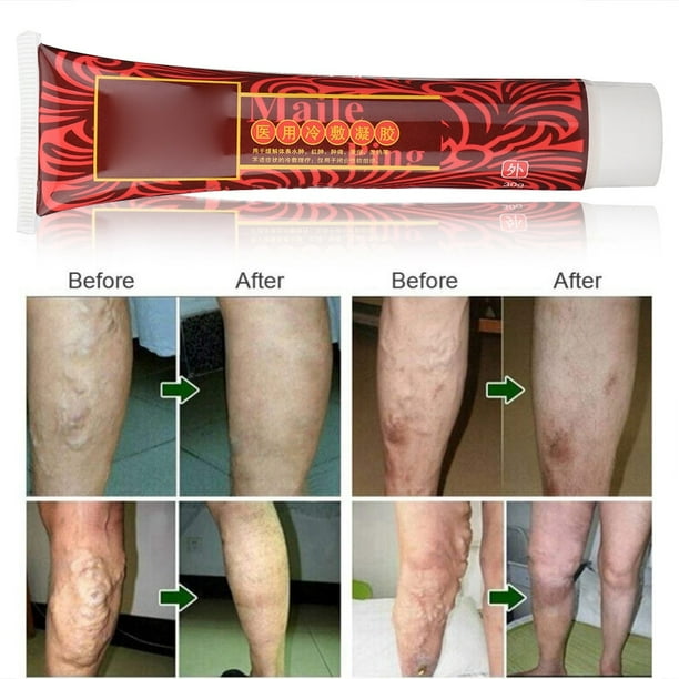 Tebru Varicose Vein Treatment,Varicose Veins Cream Varicose Vein