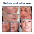 thumbnail image 4 of Black Acanthus Facial Cleanser Deep Cleansing, Softening, Skin Repair, Fading Facial Dullness, Whitening Facial Clea, 4 of 4