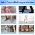 thumbnail image 5 of Nail Repair Patches, Nail Fungus Treatments, Split Nail Repair, Waterproof And Breathable Foot Care Nail Repair Extra Strong Toenail, 5 of 5