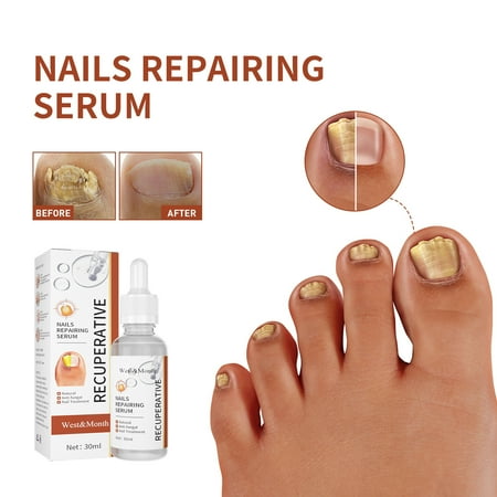1-Pack) Damaged & Brittle Nails | With Extraordinarily Powerful Repairing & Strengthening Botanicals | Professional Foot/Hand Treatment | Easy & Quick | Nail Repair Fluid - 30ML | Walmart Canada 1-Pack) Damaged & Brittle Nails | With Extraordinarily Powerful Repairing & Strengthening Botanicals | Professional Foot/Hand Treatment | Easy & Quick | Nail Repair Fluid - 30ML | Walmart Canada