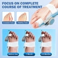 thumbnail image 3 of Bunion Corrector for Women & Men Bunion Relief Bunion Splint Toe Straightener with Adjustable Knob and Comfortable Silicone Pad for Left/Right Feet, Blue, 3 of 10