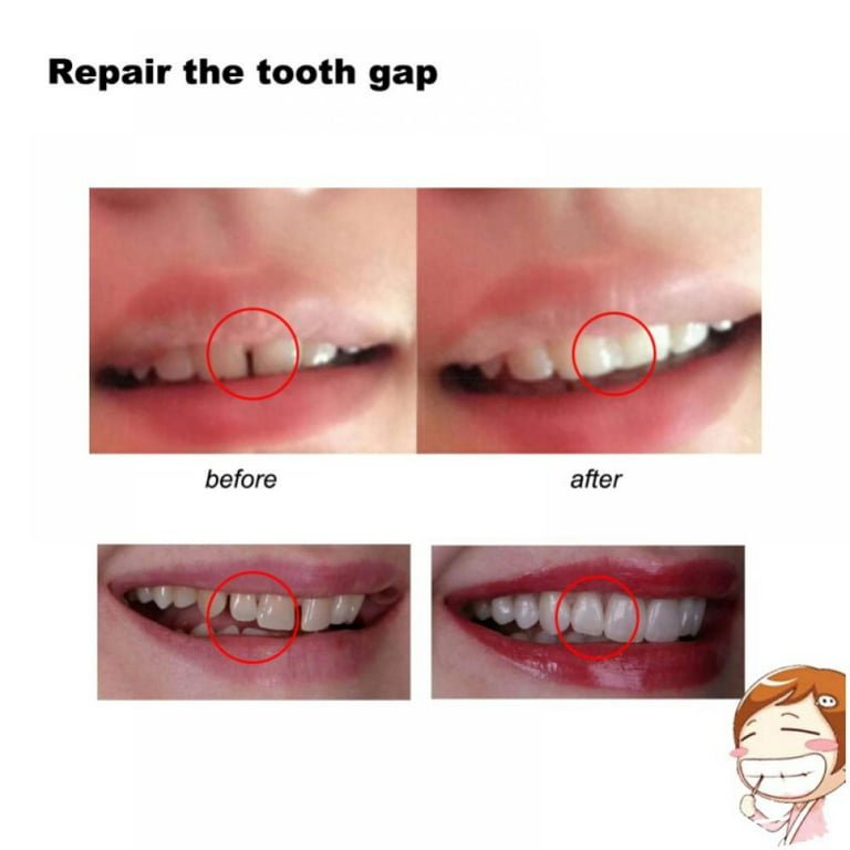 Moldable False Teeth FalsTemporary Tooth Repair Restoration Teeth Gaps  Missing Broken Tooth Filling Reusable Non-toxic