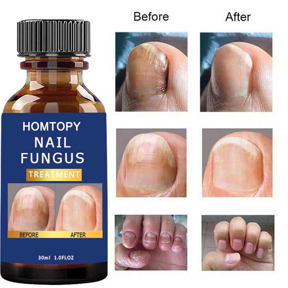 Younar Nail Strengthener Nail Repair Kit For Cracked Natural Nail Renewal Nail  Repair Solution For Discolored And Damaged Nails big sale 