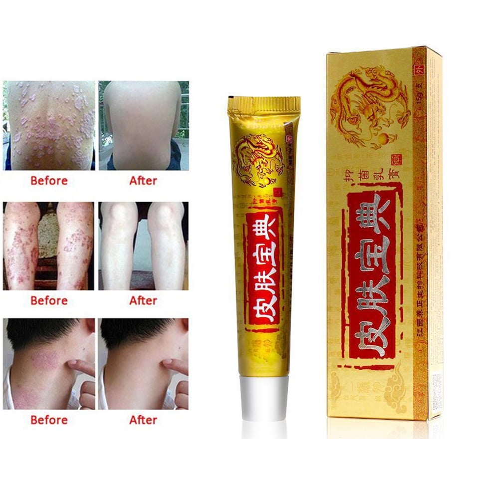 Chinese Medicine Cream Psoriasis Dermatitis Eczema Pruritus Skin ...